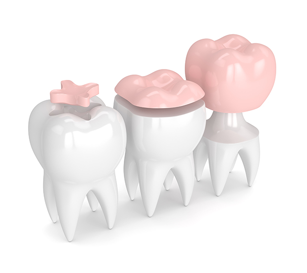 Scottsdale Dental Inlays and Onlays